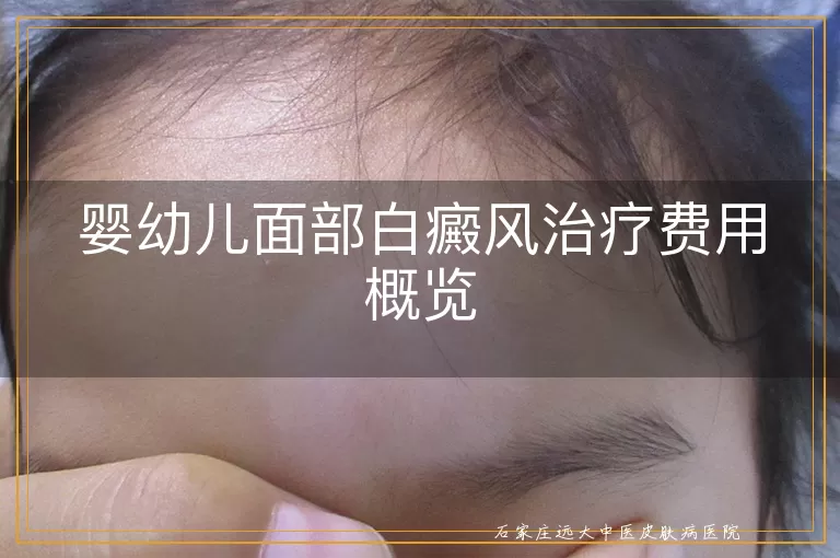 婴幼儿面部白癜风治疗费用概览