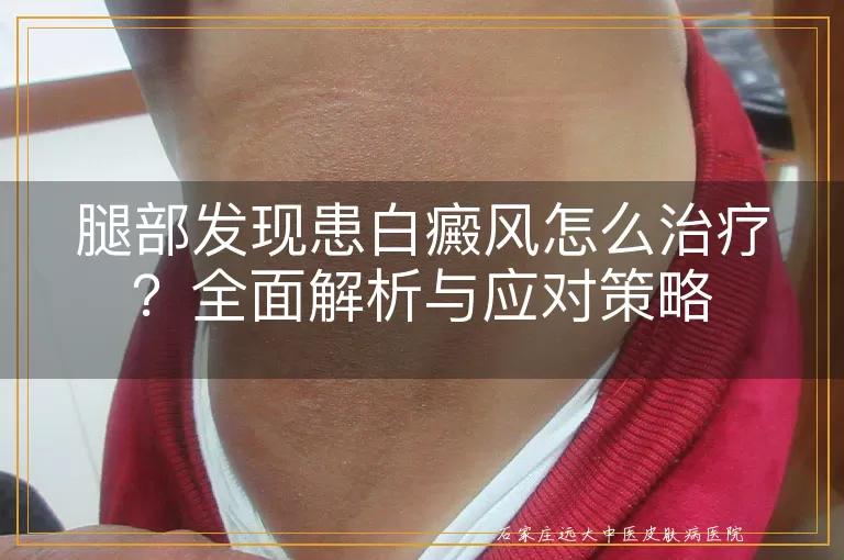腿部发现患白癜风怎么治疗？全面解析与应对策略