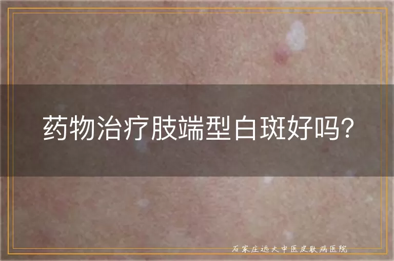 药物治疗肢端型白斑好吗？
