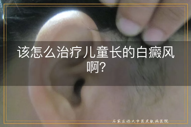 该怎么治疗儿童长的白癜风啊？