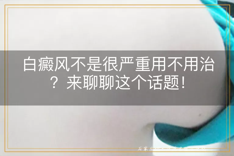 白癜风不是很严重用不用治？来聊聊这个话题！