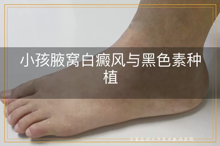 小孩腋窝白癜风与黑色素种植
