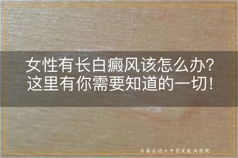 女性有长白癜风该怎么办？这里有你需要知道的一切！