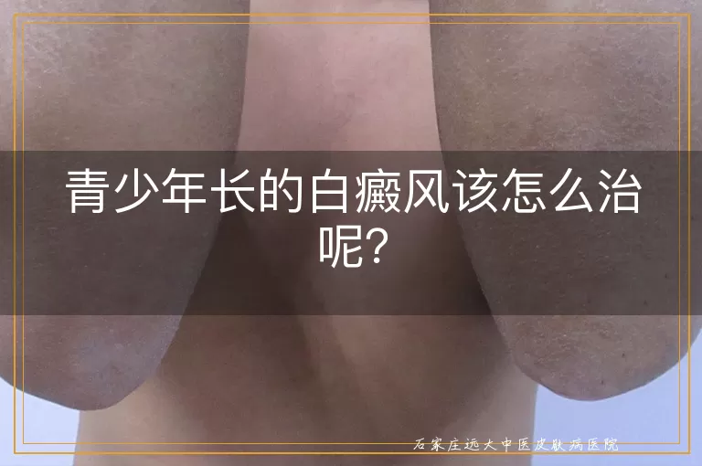 青少年长的白癜风该怎么治呢？