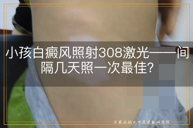 小孩白癜风照射308激光——间隔几天照一次最佳？