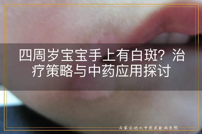四周岁宝宝手上有白斑？治疗策略与中药应用探讨