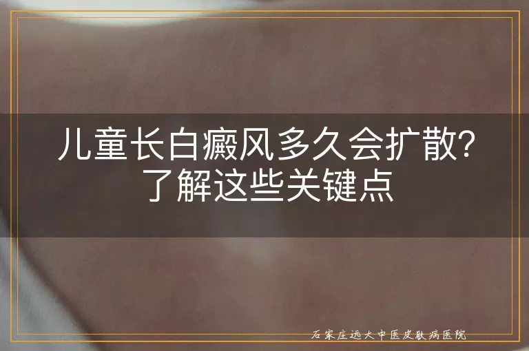 儿童长白癜风多久会扩散？了解这些关键点