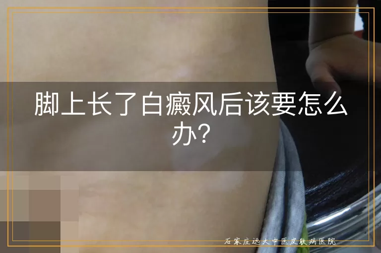 脚上长了白癜风后该要怎么办？