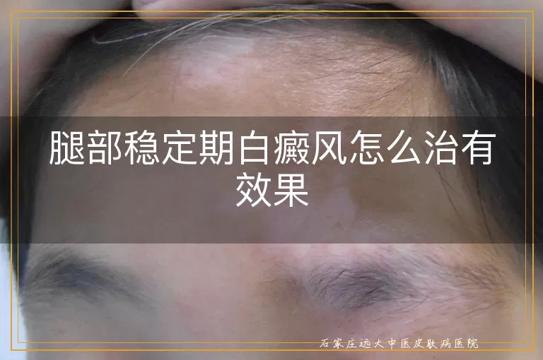 腿部稳定期白癜风怎么治有效果