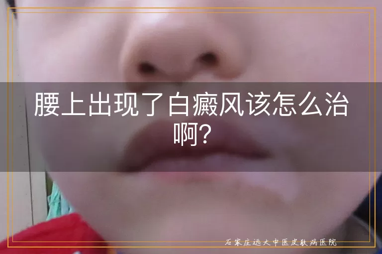 腰上出现了白癜风该怎么治啊？
