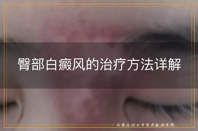 臀部白癜风的治疗方法详解