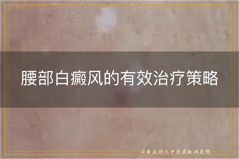 腰部白癜风的有效治疗策略