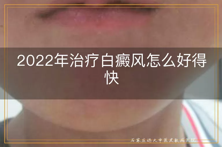 2022年治疗白癜风怎么好得快