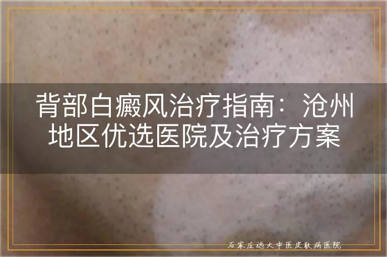 背部白癜风治疗指南：沧州地区优选医院及治疗方案