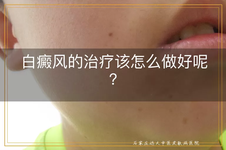 白癜风的治疗该怎么做好呢？