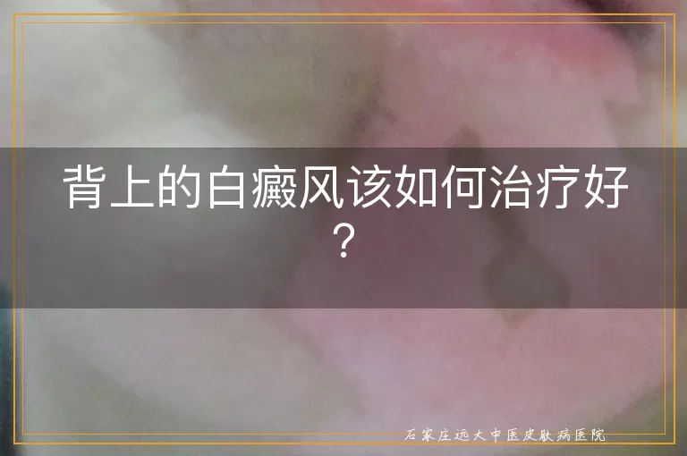 背上的白癜风该如何治疗好？