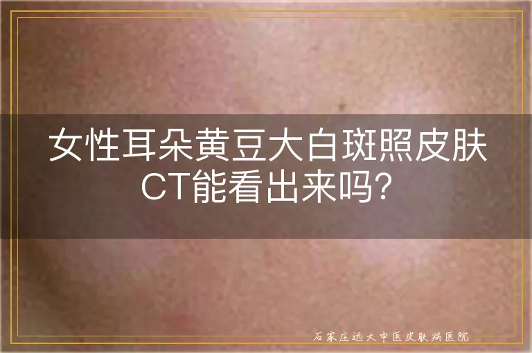女性耳朵黄豆大白斑照皮肤CT能看出来吗？
