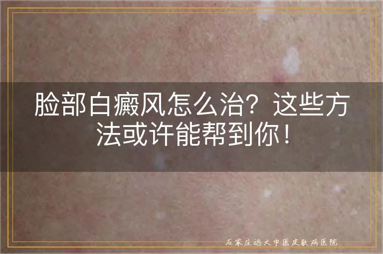 脸部白癜风怎么治？这些方法或许能帮到你！