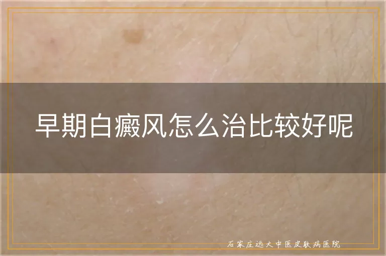 早期白癜风怎么治比较好呢