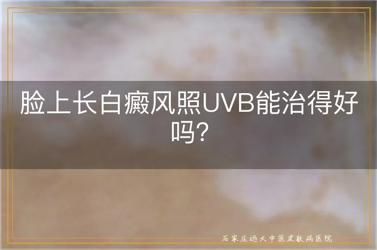 脸上长白癜风照UVB能治得好吗？