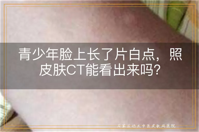 青少年脸上长了片白点，照皮肤CT能看出来吗？