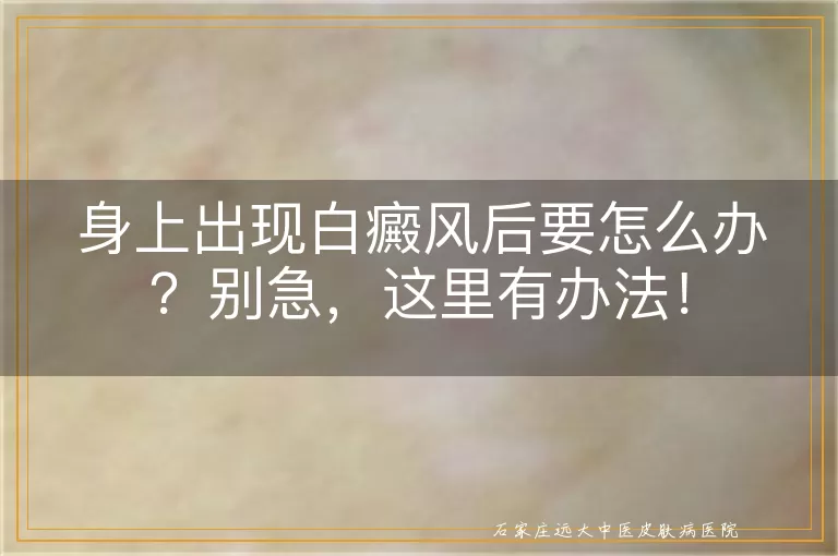 身上出现白癜风后要怎么办？别急，这里有办法！