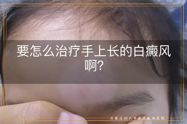 要怎么治疗手上长的白癜风啊？