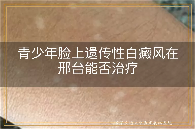 青少年脸上遗传性白癜风在邢台能否治疗