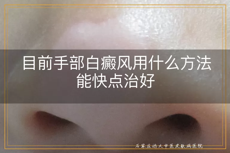目前手部白癜风用什么方法能快点治好