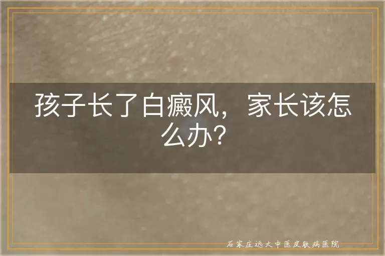 孩子长了白癜风，家长该怎么办？