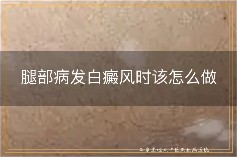 腿部病发白癜风时该怎么做