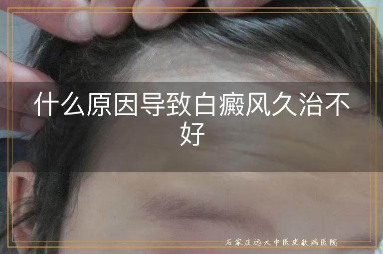 什么原因导致白癜风久治不好