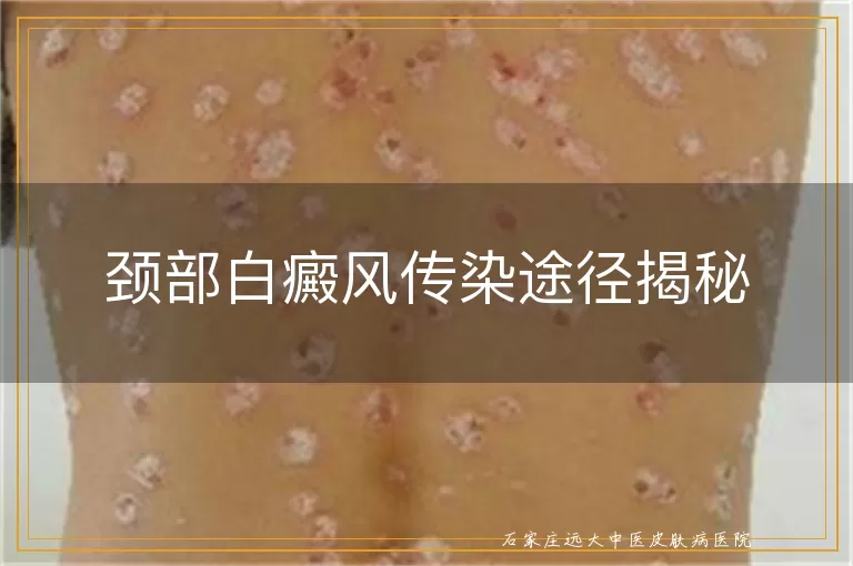 颈部白癜风传染途径揭秘