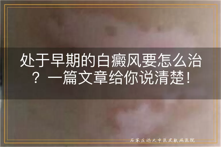 处于早期的白癜风要怎么治？一篇文章给你说清楚！