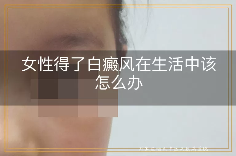 女性得了白癜风在生活中该怎么办
