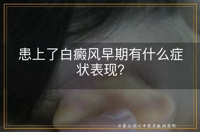 患上了白癜风早期有什么症状表现？