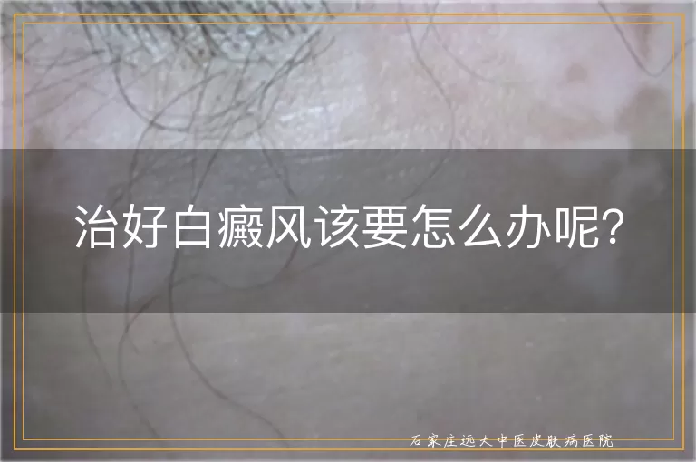 治好白癜风该要怎么办呢？