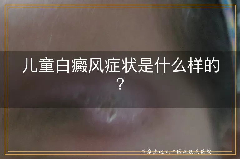 儿童白癜风症状是什么样的？