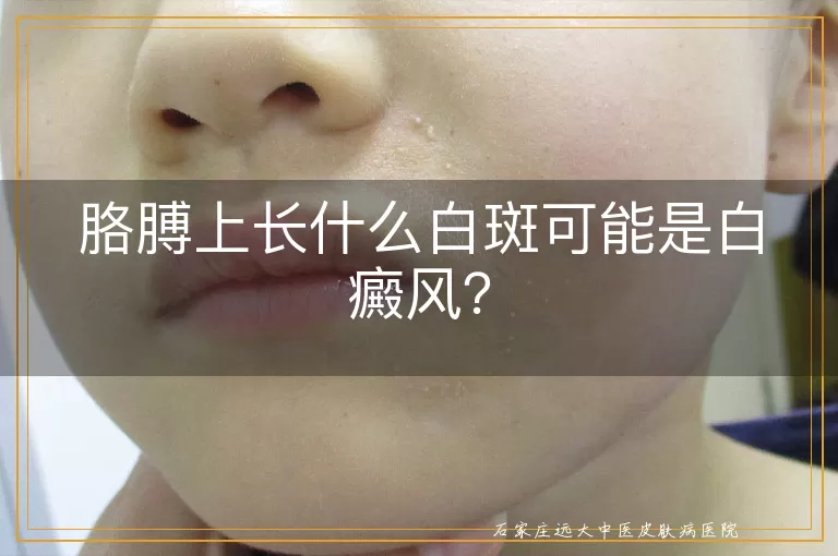 胳膊上长什么白斑可能是白癜风？