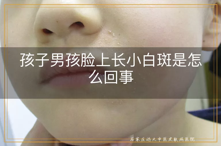 孩子男孩脸上长小白斑是怎么回事