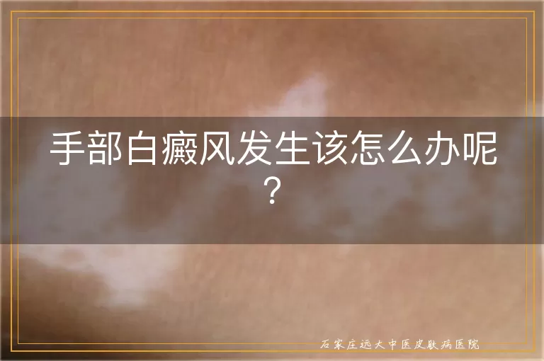 手部白癜风发生该怎么办呢？