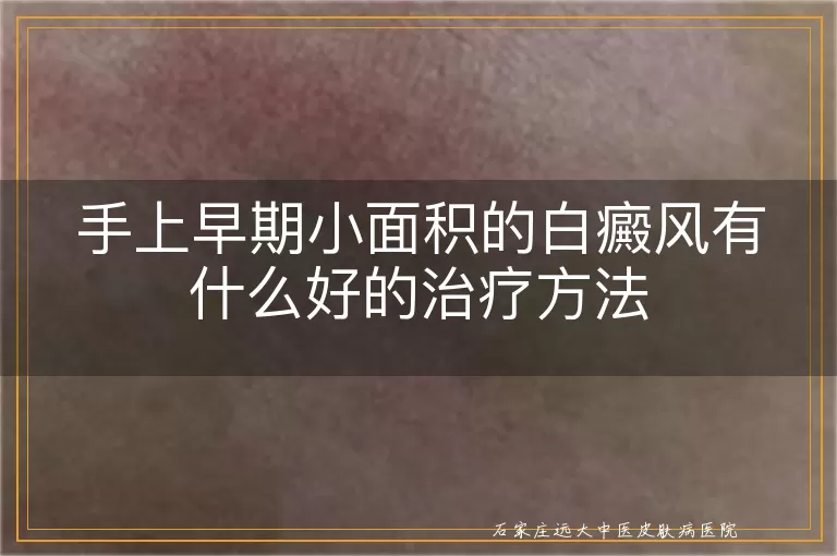 手上早期小面积的白癜风有什么好的治疗方法