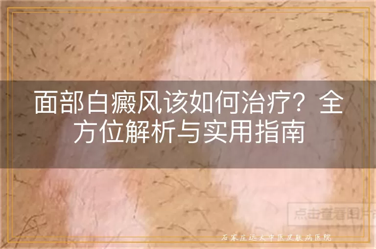 面部白癜风该如何治疗？全方位解析与实用指南