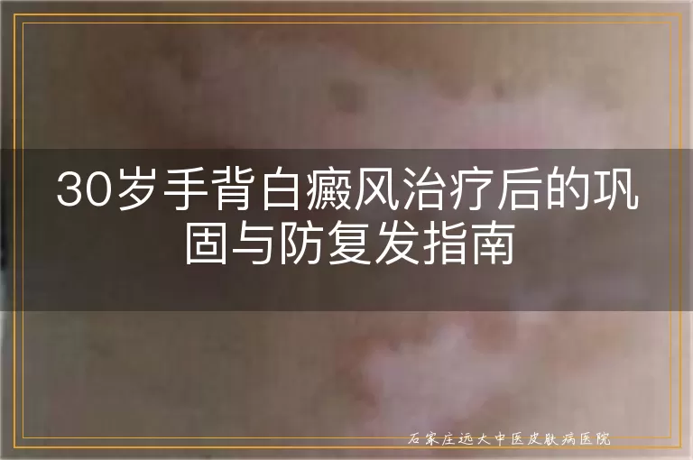 30岁手背白癜风治疗后的巩固与防复发指南