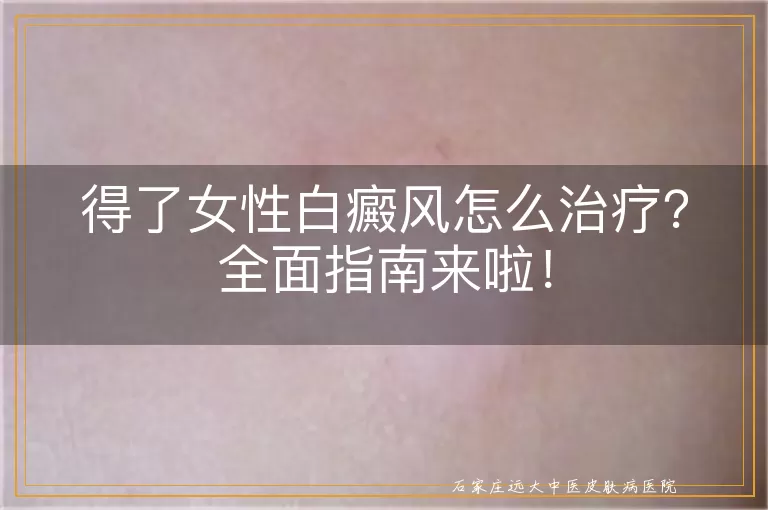 得了女性白癜风怎么治疗？全面指南来啦！