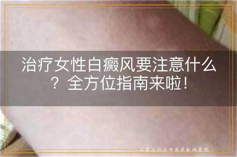 治疗女性白癜风要注意什么？全方位指南来啦！