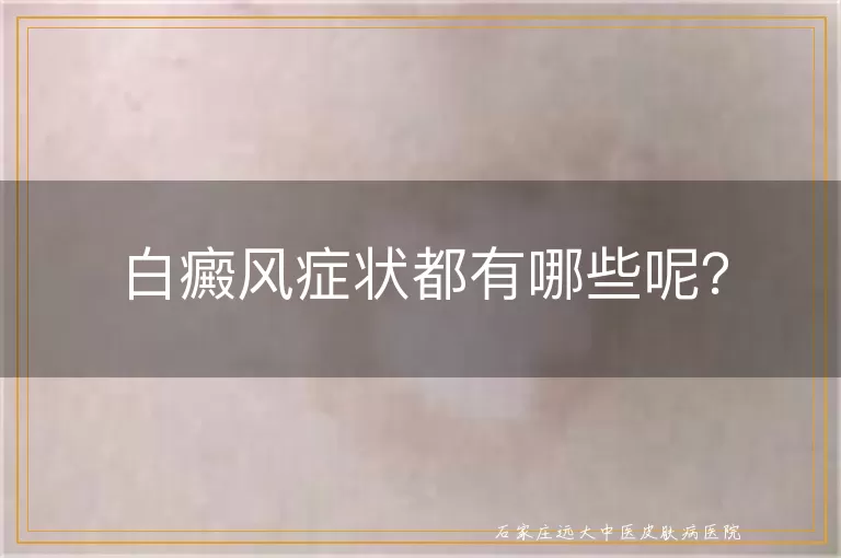 白癜风症状都有哪些呢？