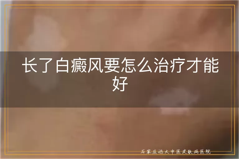 长了白癜风要怎么治疗才能好