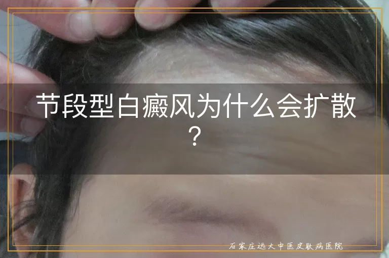 节段型白癜风为什么会扩散？