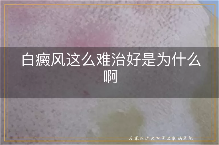 白癜风这么难治好是为什么啊